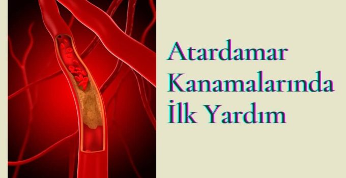 Atardamar (arter) Kanaması | Atardamar Kanamalarında İlk Yardım