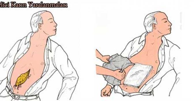 DELİCİ KARIN YARALANMALARI