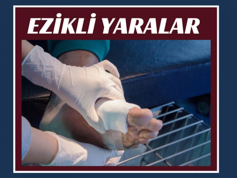 Ezikli yaralar