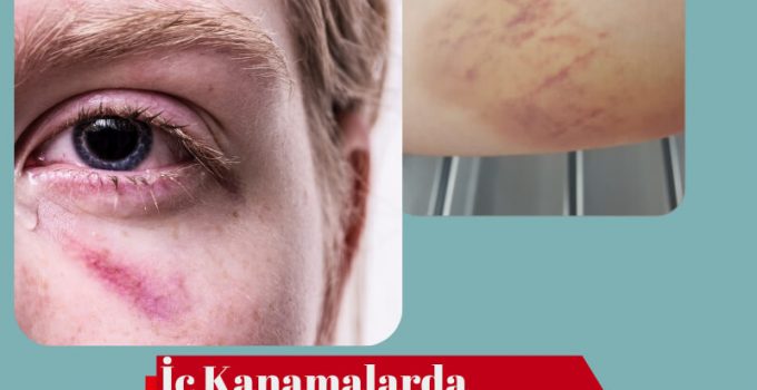 İç Kanama: Nedir, Türleri ve Belirtileri