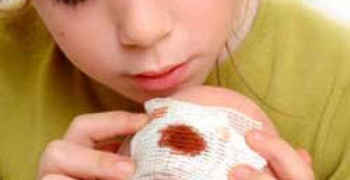 KANAMALARDA YAPILMASI GEREKEN İLKYARDIM UYGULAMALARI NELERDİR? KANAMALARDA YAPILMASI GEREKEN İLKYARDIM UYGULAMALARI NELERDİR?