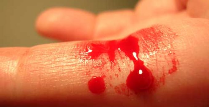 KILCAL DAMAR KANAMASI