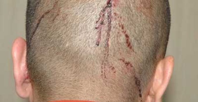 SAÇLI DERİDE YARALANMALAR